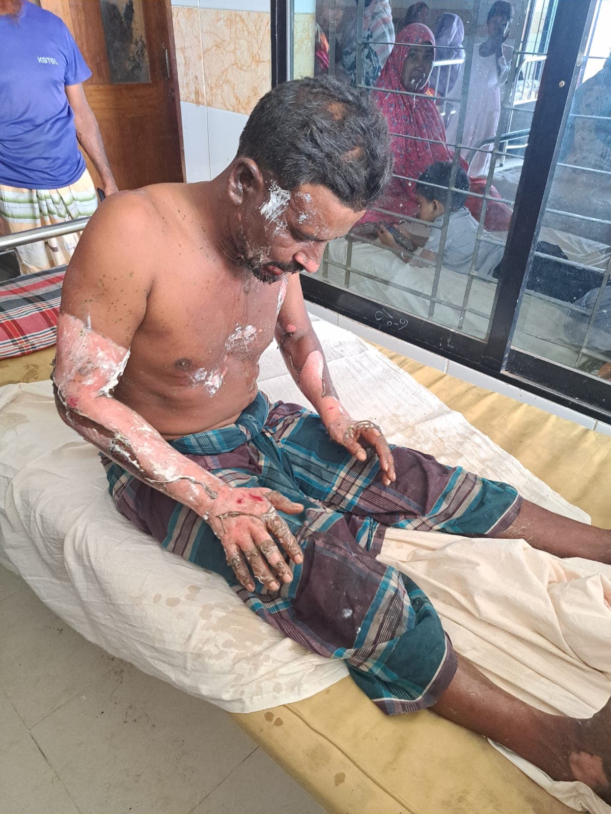 পেট্রোল ঢেলে শ্রমিক সর্দারকে পুড়িয়ে দেওয়ার অভিযোগ, রাজশাহী মেডিক্যালে চিকিৎসাধীন
